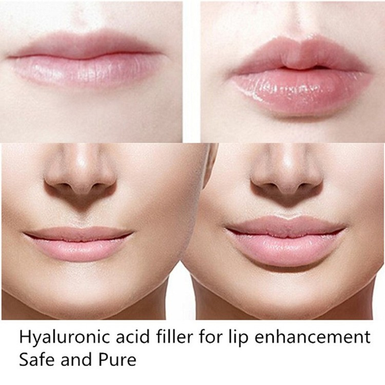 Hyaluronic Acid Descr