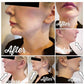 Powerful fat dissolving  | Facial & body fat decomposition | Slimming and firming