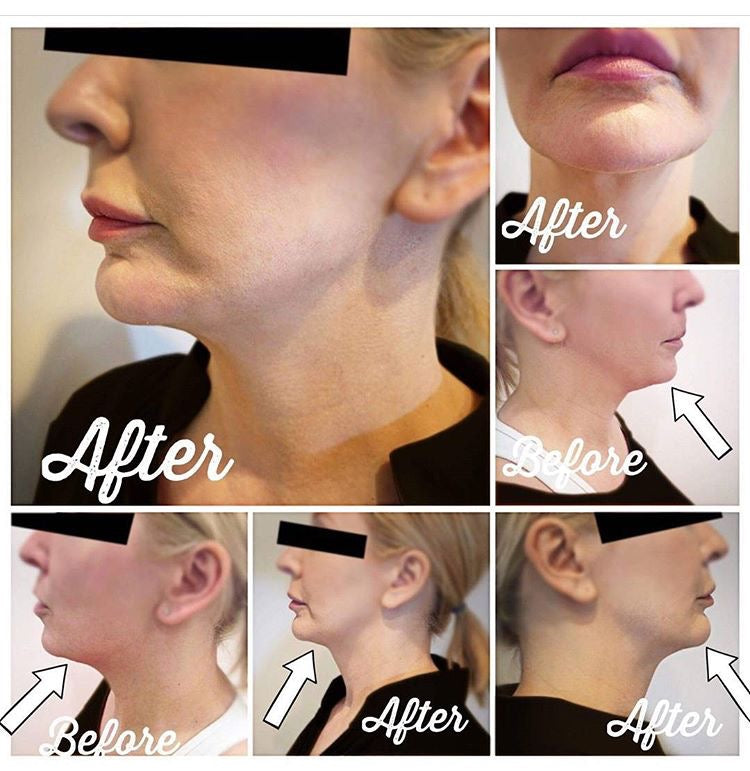 Powerful fat dissolving  | Facial & body fat decomposition | Slimming and firming