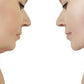 Powerful fat dissolving  | Facial & body fat decomposition | Slimming and firming